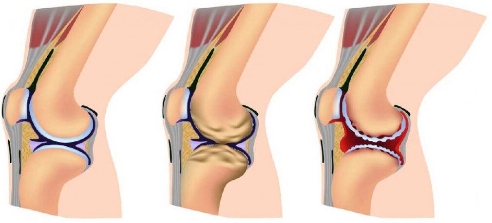 Gesunde Artikulation und durch Arthrose getroffen