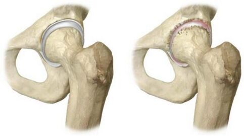 gesundes Hüftgelenk und von Arthrose betroffen